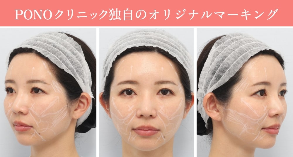 PONOクリニック独自のオリジナルマーキング