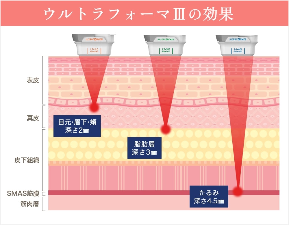 ウルトラフォーマーⅢの効果