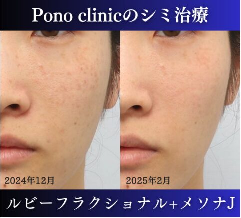 ルビーフラクショナル、メソナJ