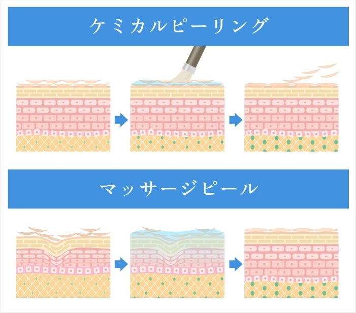 ケミカルピーリング/マッサージピールイラスト