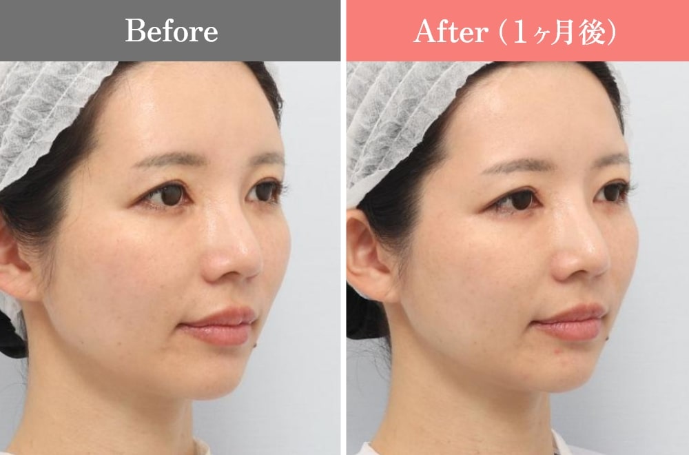 ポテンツァの症例写真