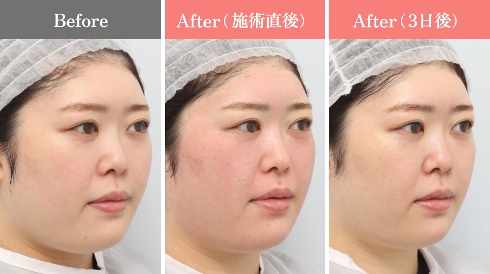 ポテンツァの症例写真