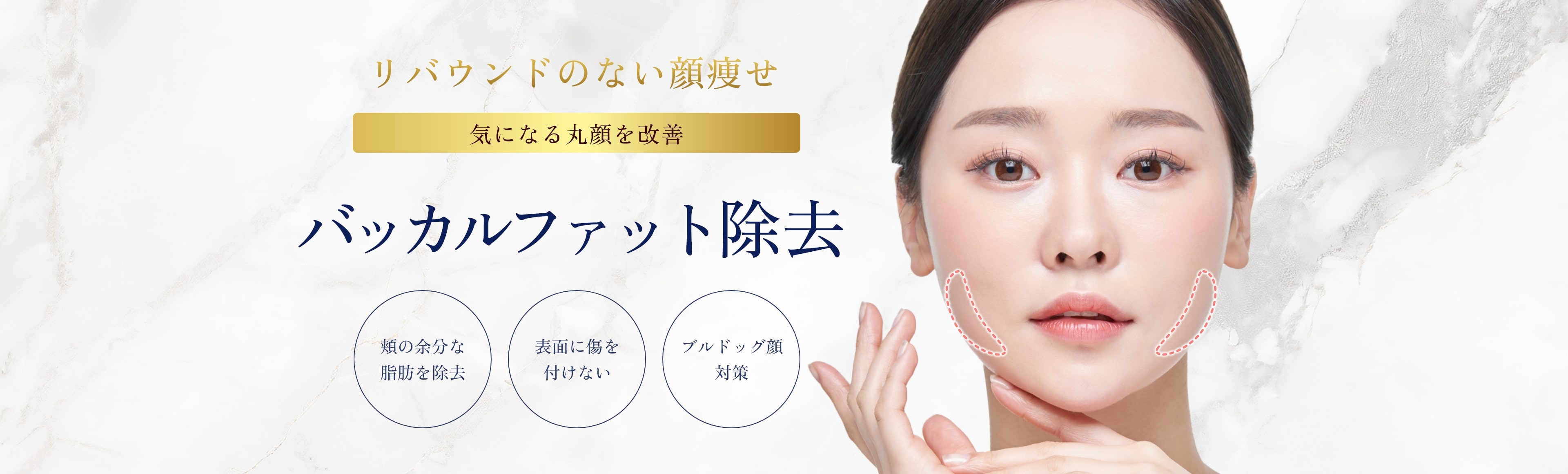 バッカルファット除去