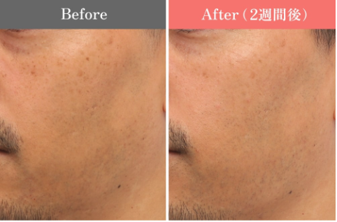 ルビーフラクショナル症例/男性