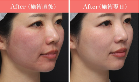 ルビーフラクショナル症例