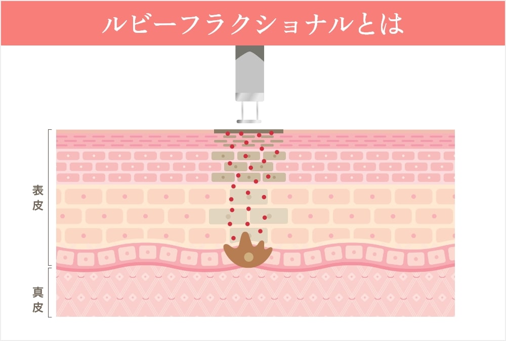 ルビフラクショナルとは/イラスト