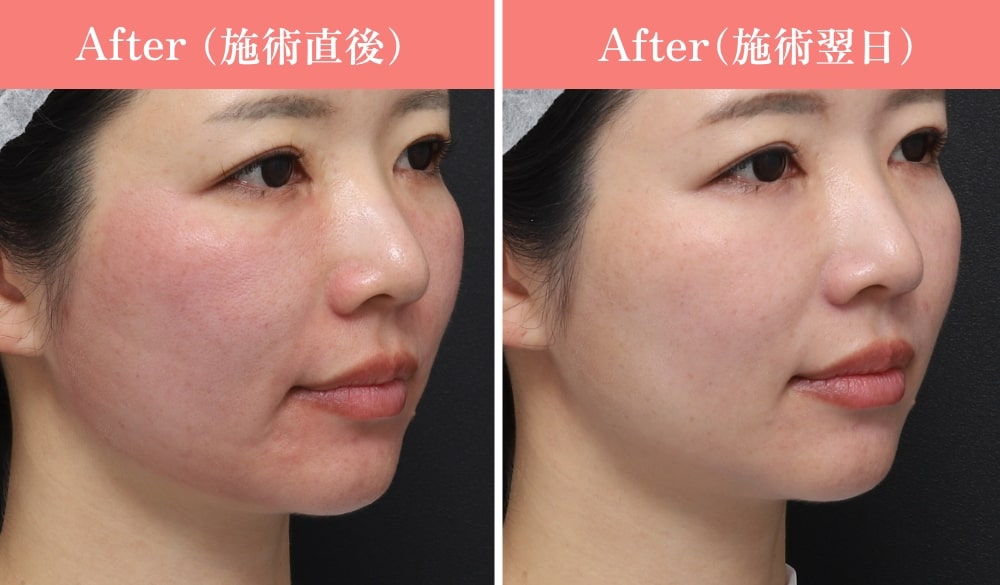 ルビーフラクショナル症例/女性