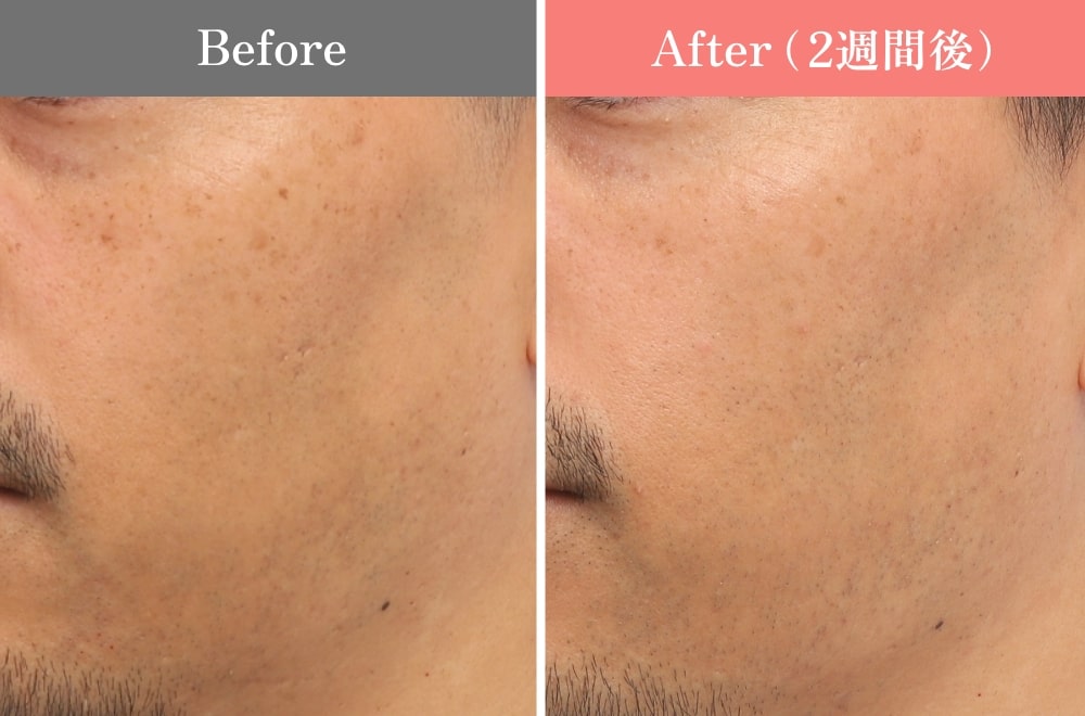 ルビーフラクショナル症例/男性