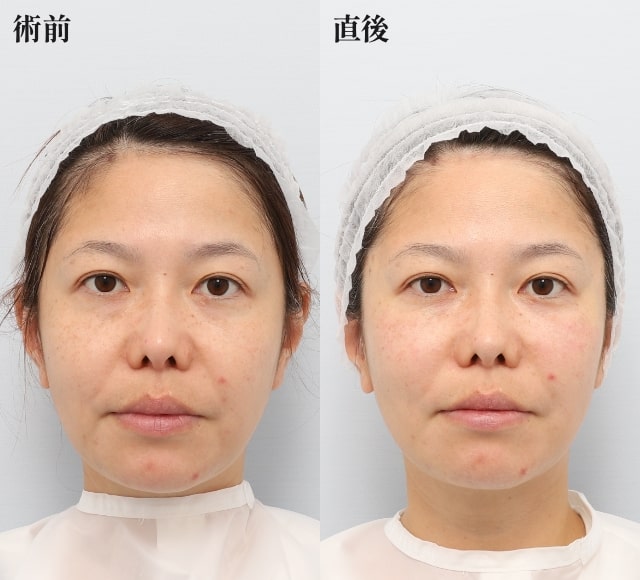 糸リフトの症例、前