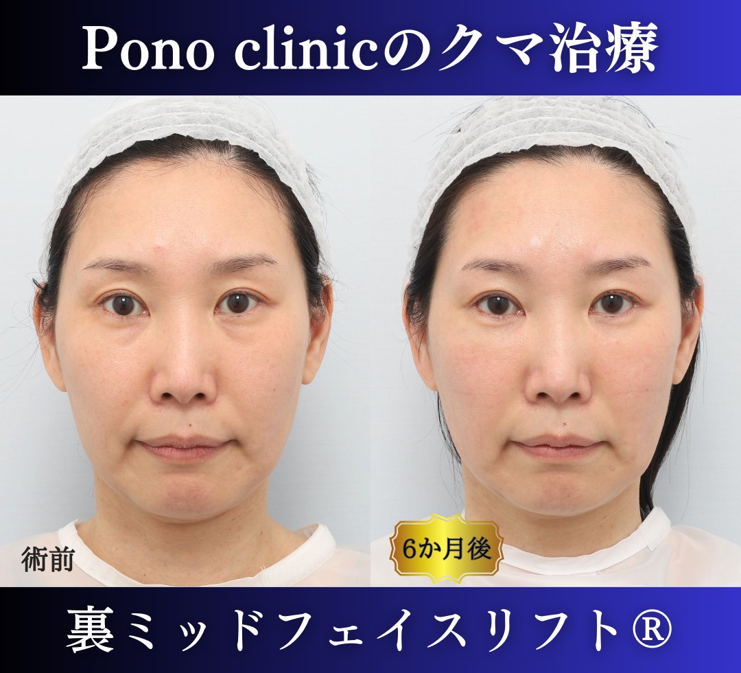 裏ミッドフェイスリフト®（裏ハムラを含む）、グラマラスライン形成、目尻切開