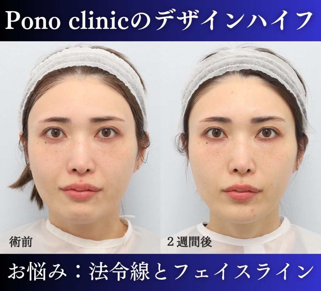 医療ハイフの症例、30代女性 (2)