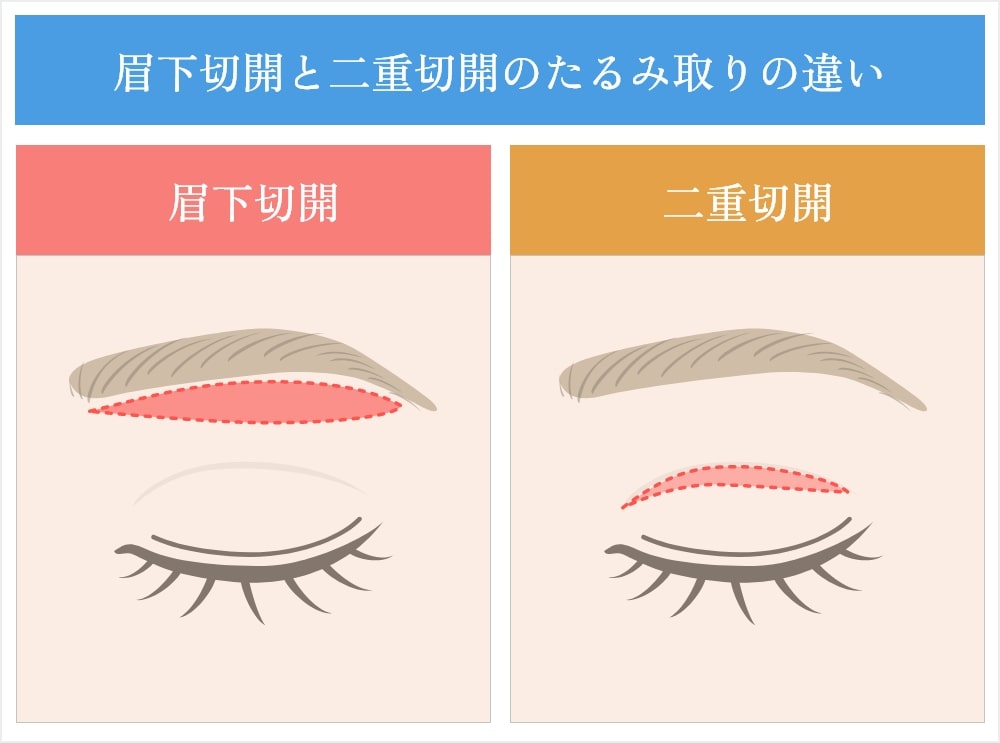 眉下切開と二重切開たるみ取りの違い/イラスト