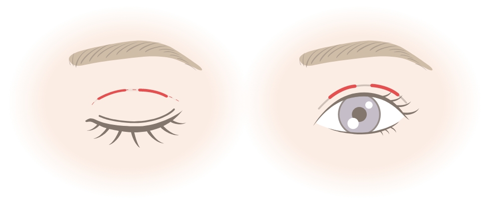 埋没法の施術方法