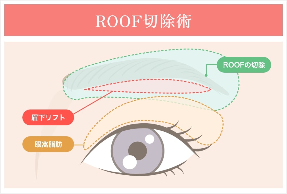 ROOF切除術/イラスト