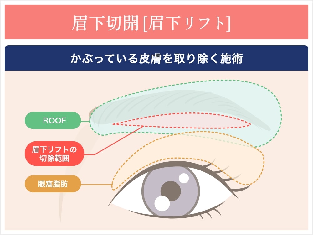 眉下切開/イラスト