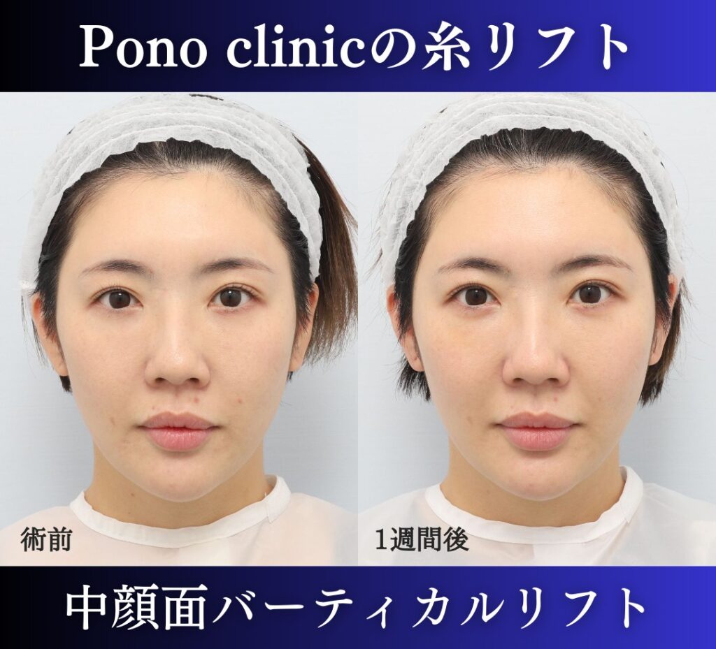 糸リフト、中顔面バーティカルリフトの症例、30代女性