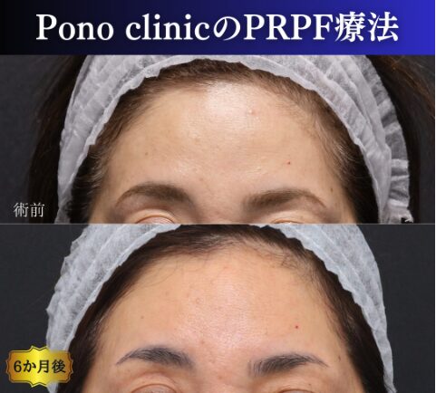PRPF®療法（額）