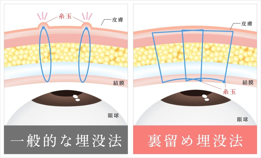 一般的な埋没法と裏留めの違い