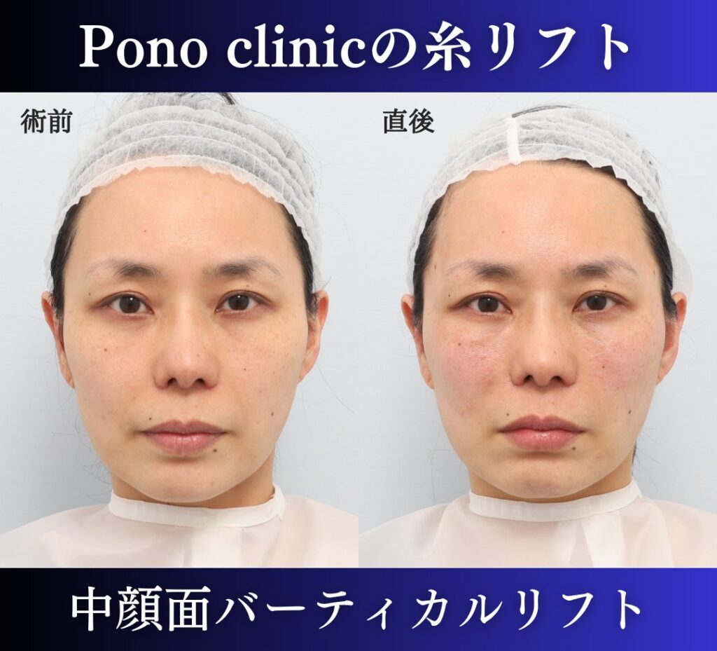 中顔面バーティカルリフト症例、前