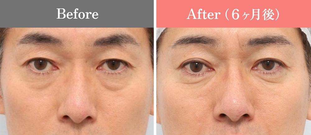 眉下リフトの症例写真/男性