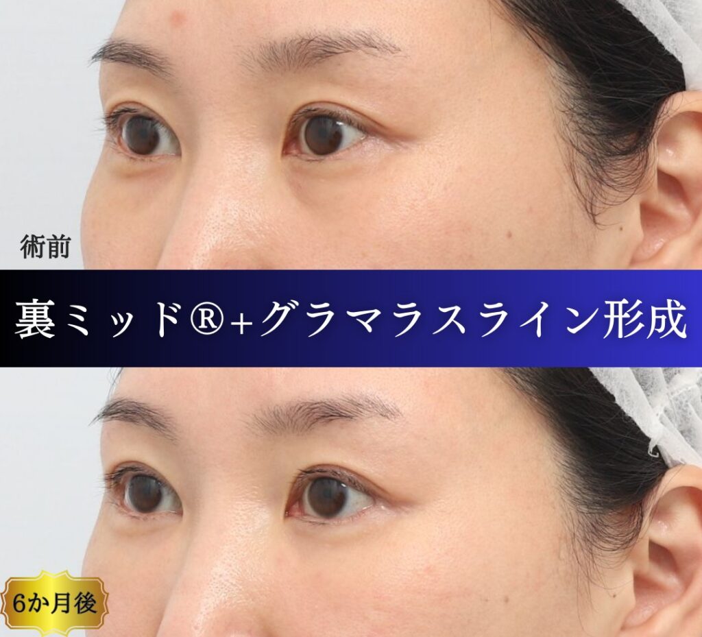 case01.裏ミッドフェイスリフト®（裏ハムラを含む）、グラマラスライン形成（目尻切開を含む）