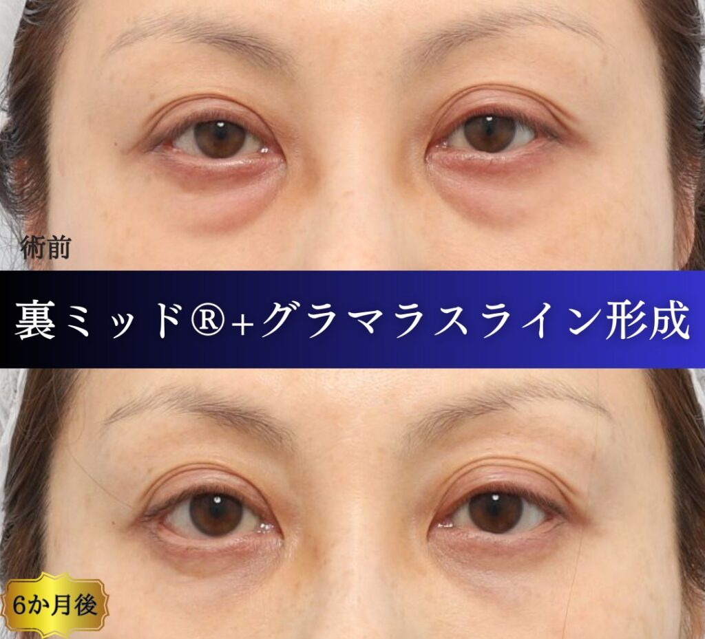 case02.裏ミッドフェイスリフト®（裏ハムラを含む）®、グラマラスライン形成（目尻切開含む）