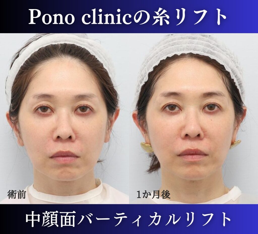 糸リフトの症例、前