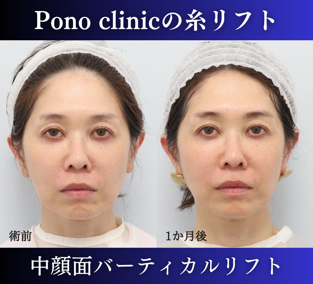 糸リフトの症例、前