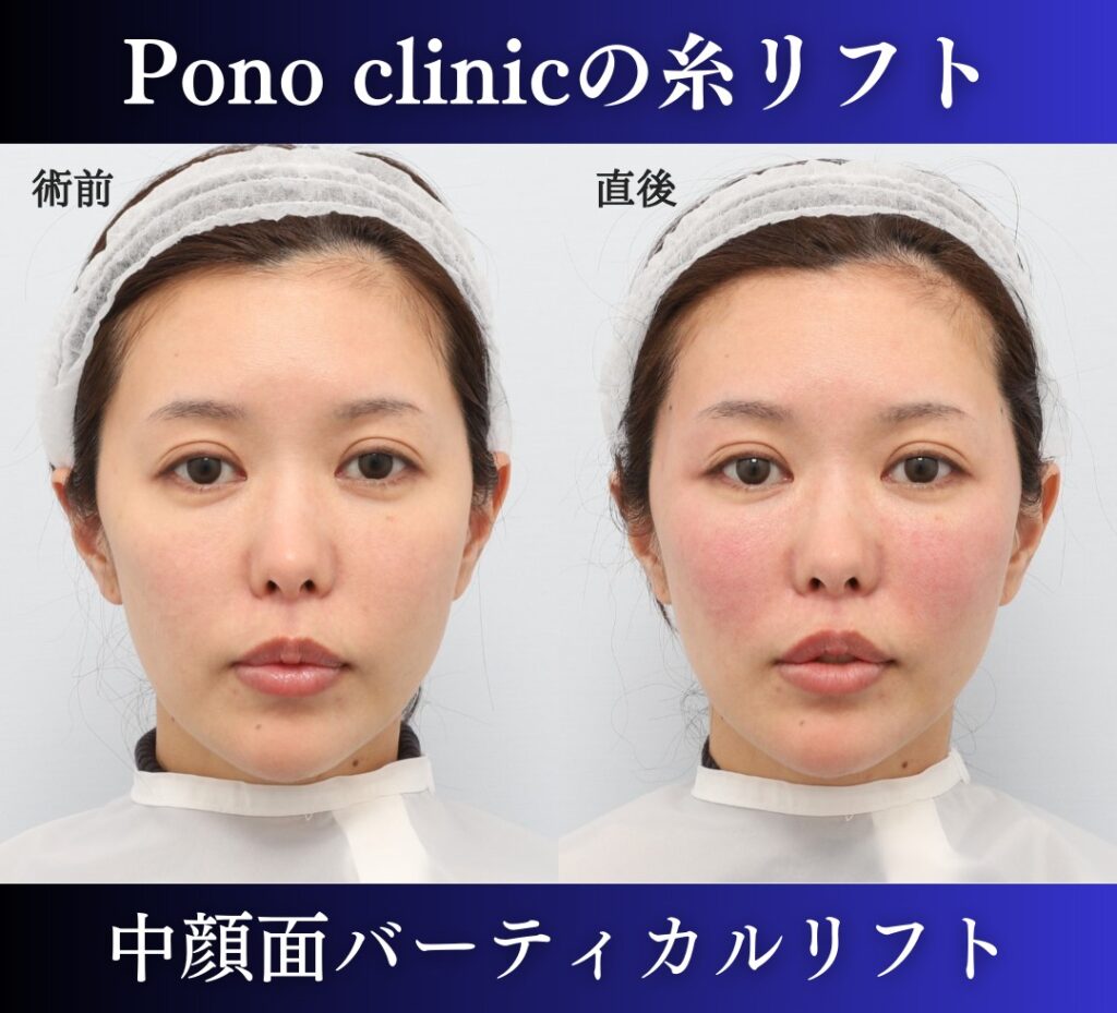 中顔面バーティカルリフト症例、直後