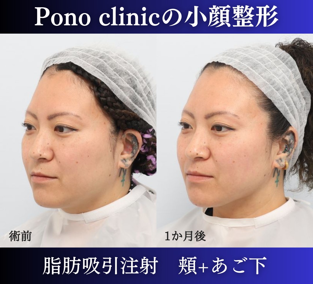 脂肪吸引注射頬あご下の症例、1か月後