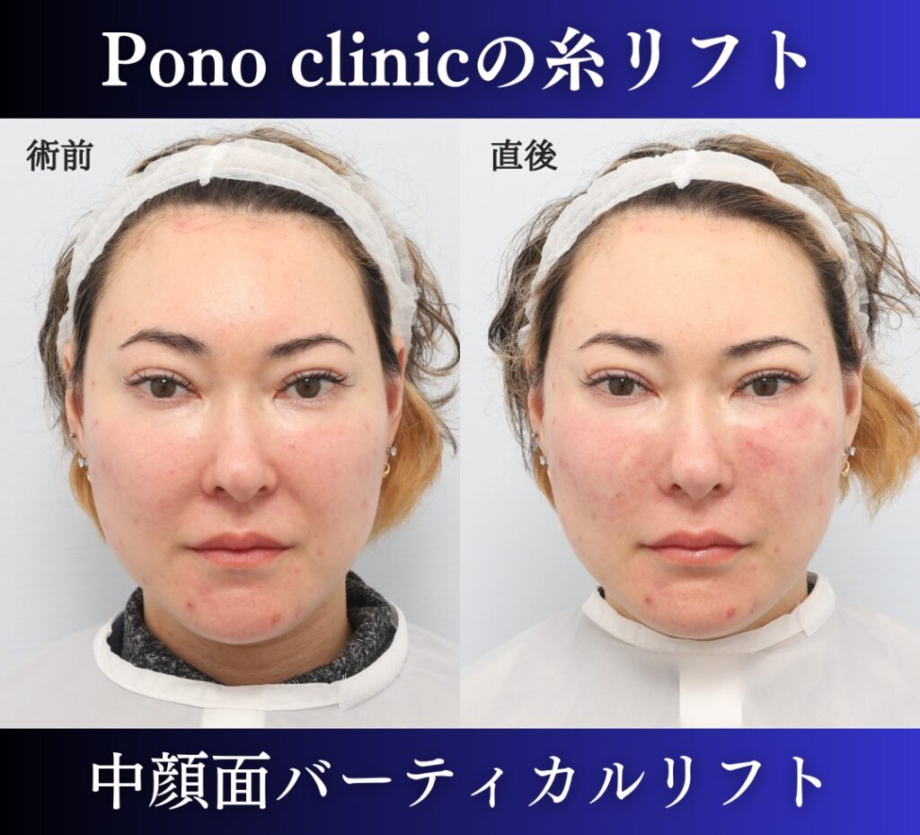 中顔面バーティカルリフト症例、前