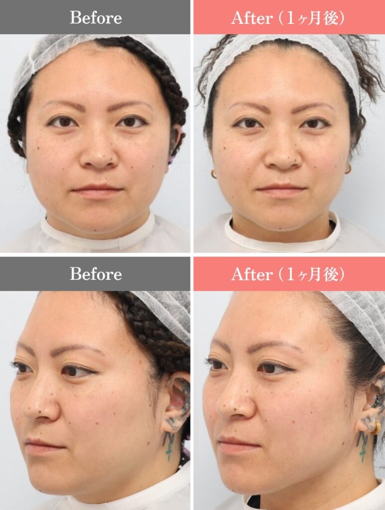 顔の脂肪吸引症例