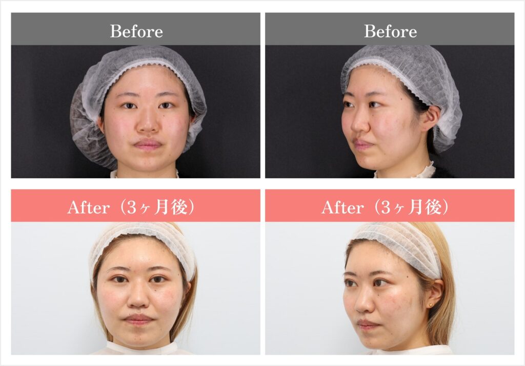 顔の脂肪吸引注射症例