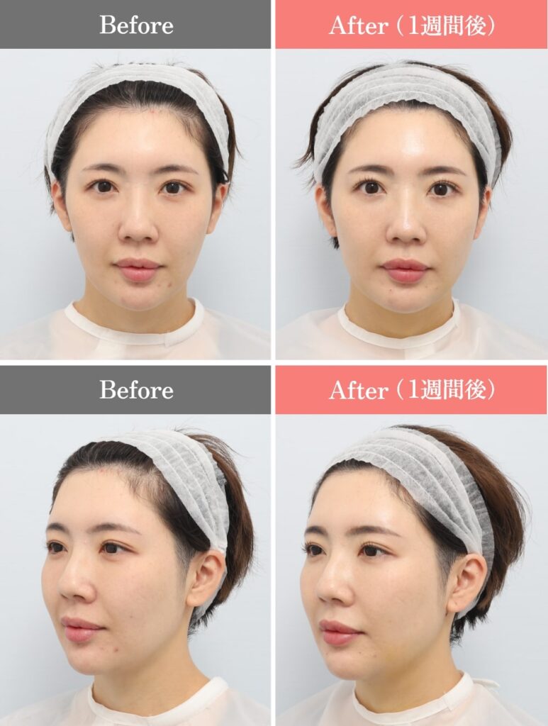 顔の脂肪吸引症例