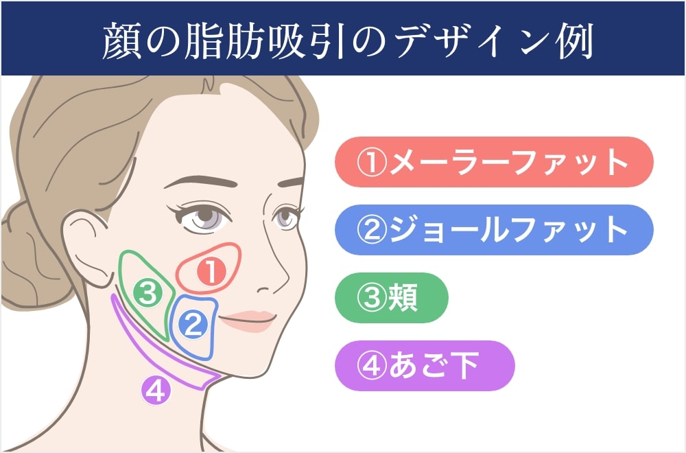 顔の脂肪吸引のデザイン例