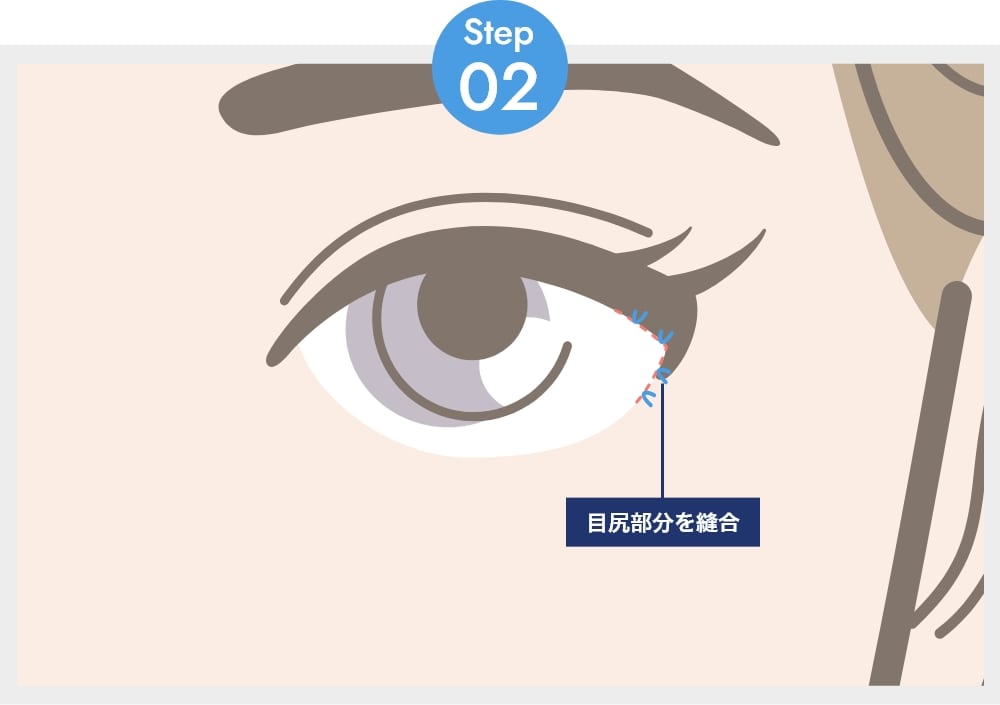 目尻部分を縫合