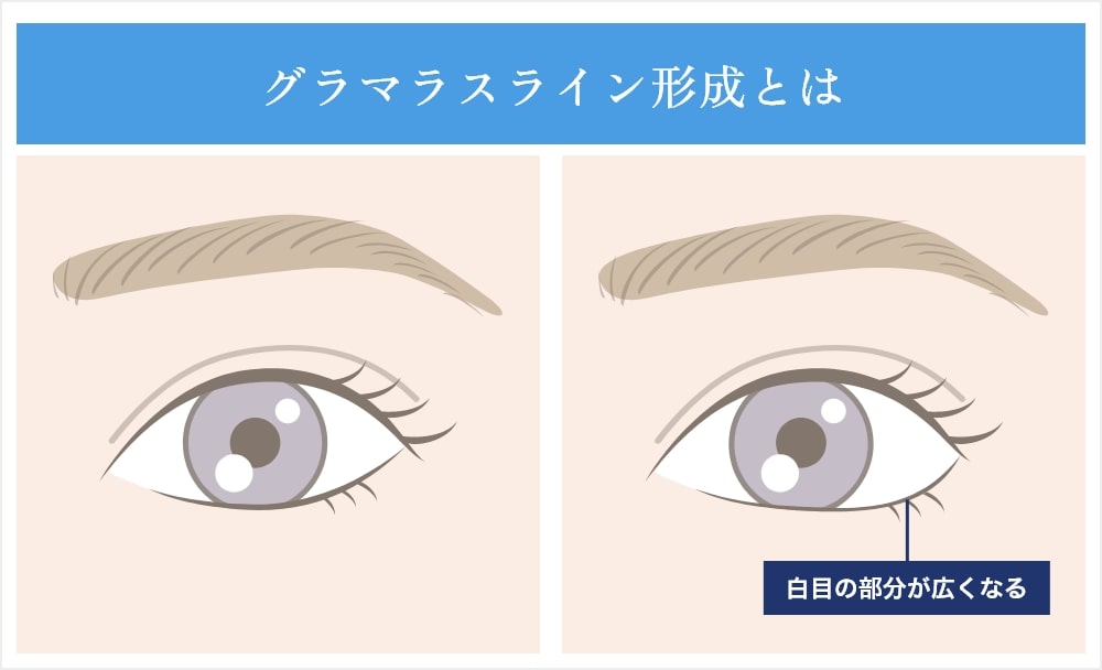グラマラスライン形成とは