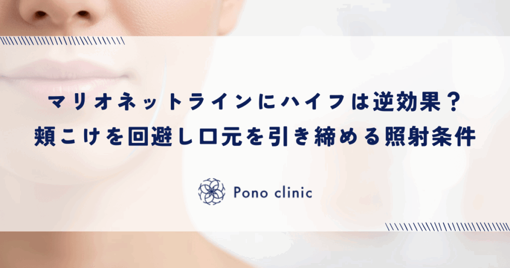 マリオネットラインにハイフ（HIFU）は逆効果？｜「頬こけ」を回避し口元を引き締める照射条件