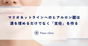 マリオネットラインへのヒアルロン酸は「支柱」を作る｜溝を埋めるだけの注入が不自然になる理由