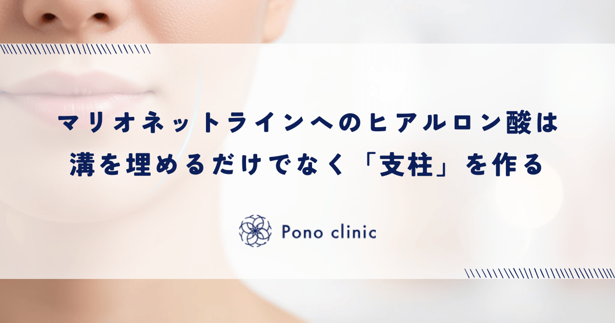 マリオネットラインへのヒアルロン酸は「支柱」を作る|溝を埋めるだけの注入が不自然になる理由