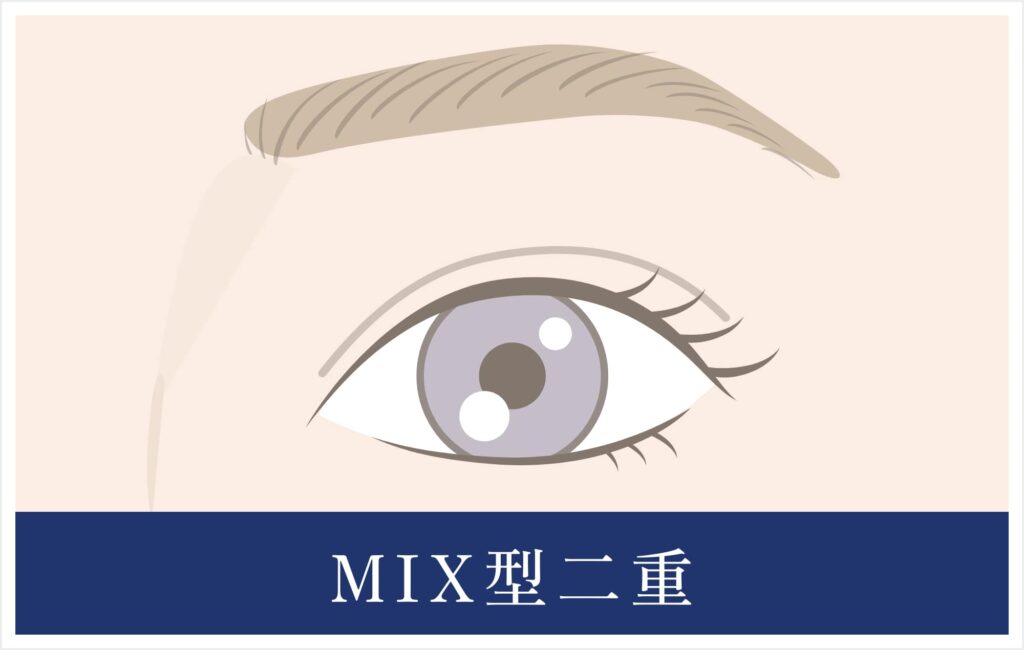 MIX型二重イラスト
