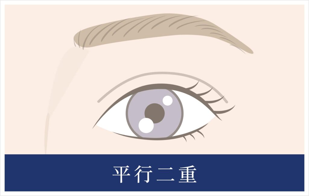 平行二重イラスト