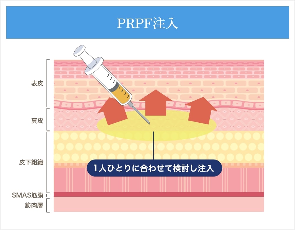 prpf注入