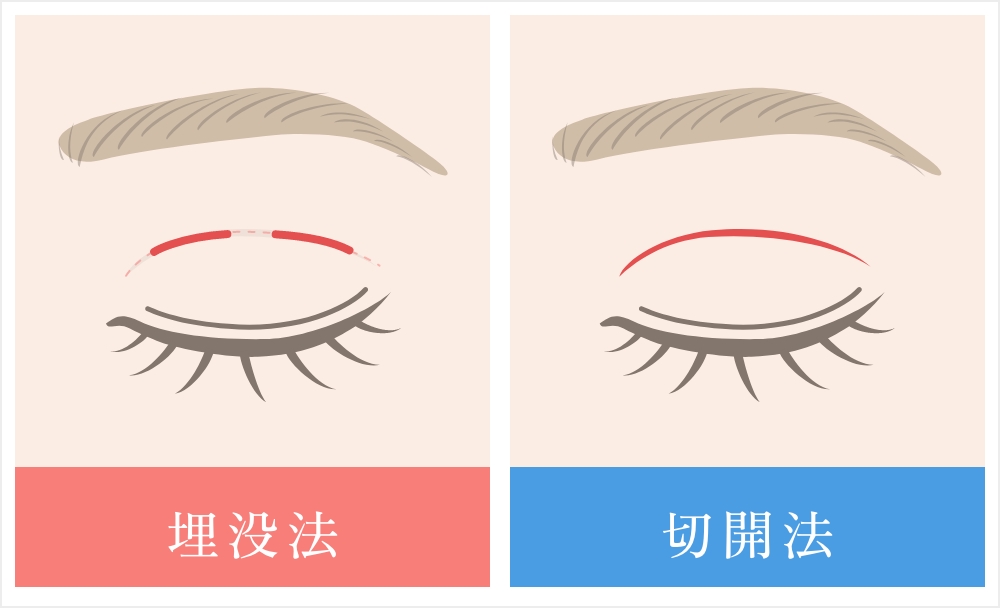 埋没法と切開法の違い