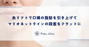 糸リフトで口横の脂肪（ジョールファット）を引き上げる｜マリオネットラインの段差をフラットにする