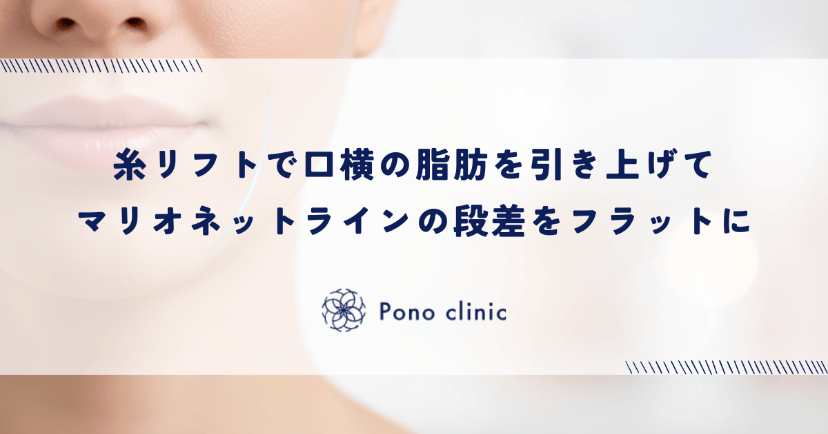 糸リフトで口横の脂肪(ジョールファット)を引き上げる|マリオネットラインの段差をフラットにする