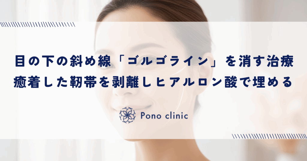 目の下の斜め線「ゴルゴライン」を消す治療｜癒着した靭帯を剥離しヒアルロン酸で埋める