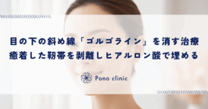目の下の斜め線「ゴルゴライン」を消す治療｜癒着した靭帯を剥離しヒアルロン酸で埋める