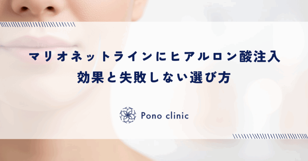 マリオネットラインにヒアルロン酸注入｜効果と失敗しない選び方