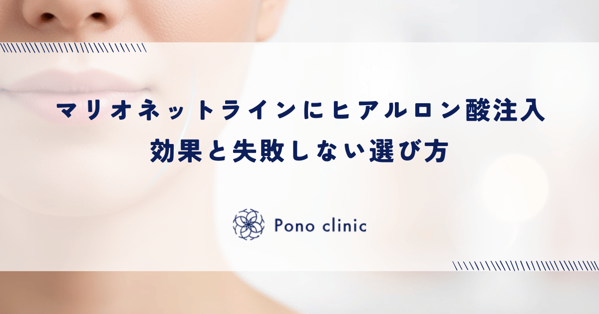 マリオネットラインにヒアルロン酸注入|効果と失敗しない選び方